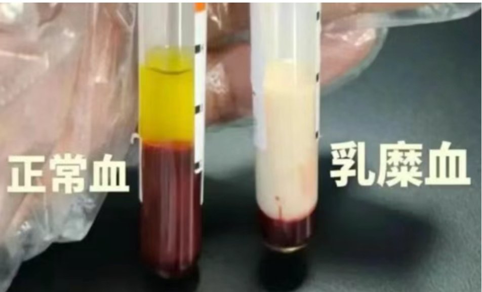Hastaneye Yatırılan Adamın Kanı Süt Rengine Dönüştü